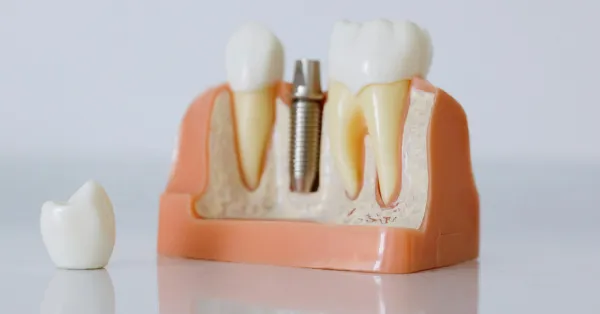 dental-implants-in-chitradurga