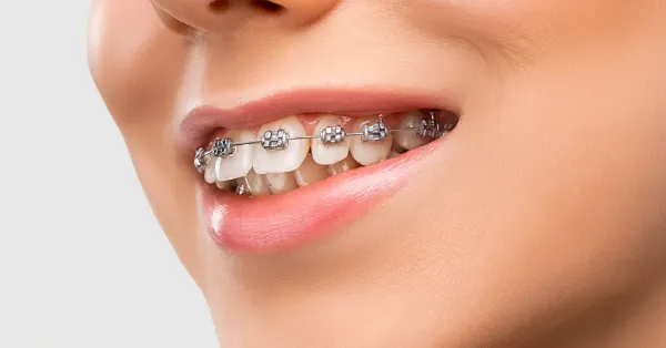 orthodontics-in-chitradurga
