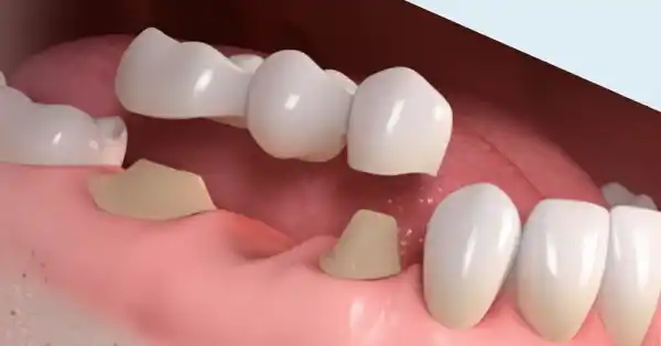 prosthodontics-in-chitradurga