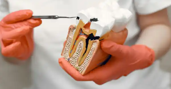 root-canal-treatment-in-chitradurga