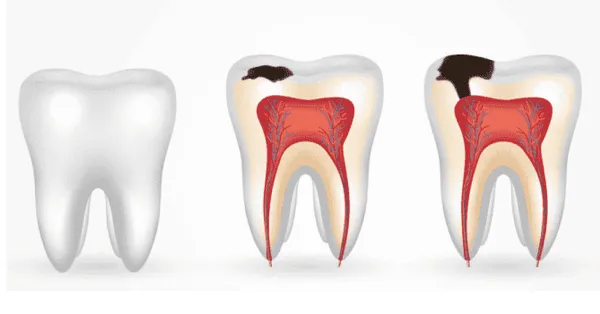 tooth-decay-treatment-in-chitradurga